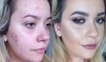 Акнето унищожава целия живот на момичетата