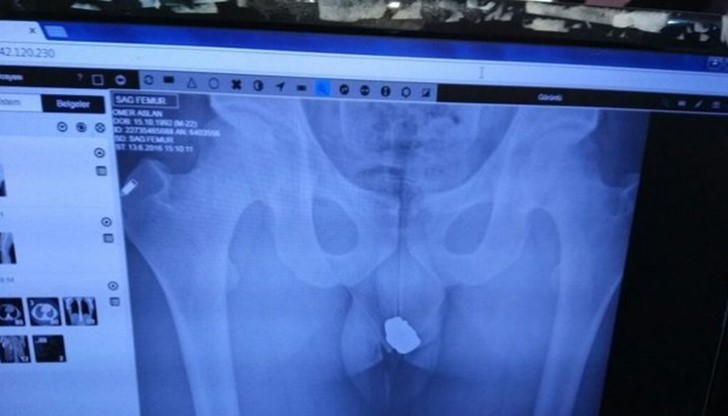 Рентгеновите снимки показват, че ценните пръстени се крият в ректума на заподозрения Рентгеновите снимки показват, че ценните пръстени се крият в ректума на заподозрения