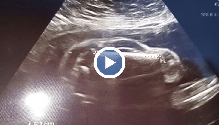 Снимка на ултразвук на бебе напомня на спортна кола