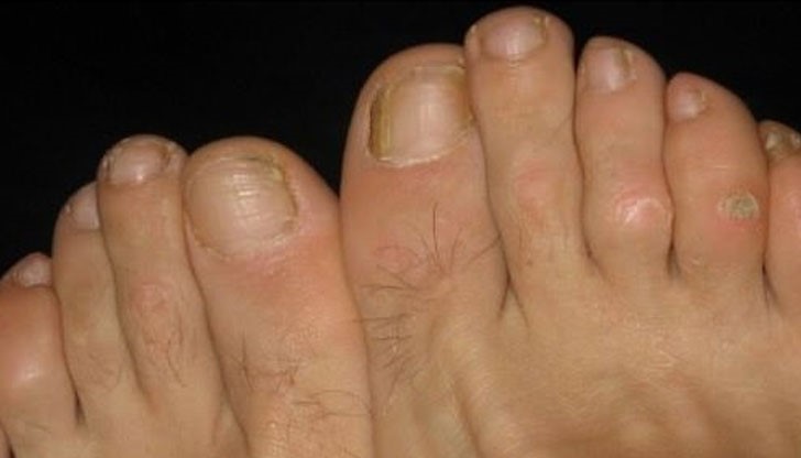 Най-добрата част за мазолите е, че може да се лекуват лесно у дома