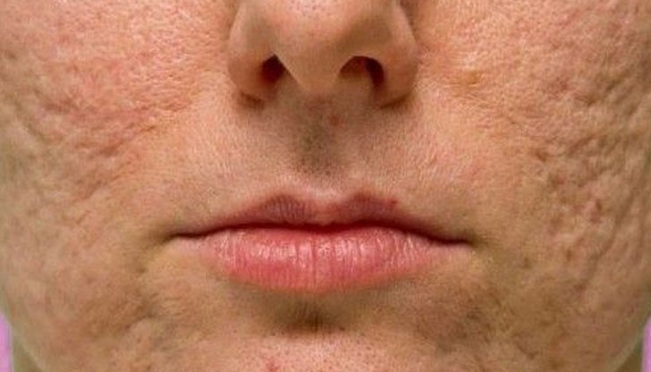 Белезите са упорити, но понякога с часове усилия те изчезват