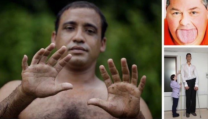 Най-удивителните аномалии в човешката анатомия, които могат да се срещнат на планетата