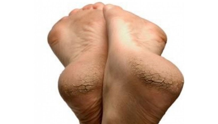 Маската за крака с овесени ядки е чудесен начин да направите скраб за напуканите пети