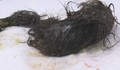 Хирурзи извадиха 3 килограма топка коса от стомаха на дете