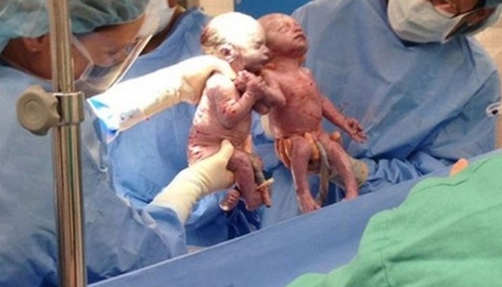 Джена и Джилиан са медицински феномен, който се случва веднъж на 10 хиляди