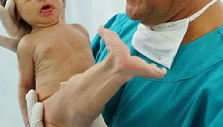 „Синдромът на русалката” е рядка деформация, при която краката са се сраснали един с друг и приличат на опашката на русалка