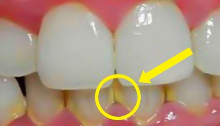 Тези популярни рецепти не вредят на зъбния емайл, те просто омекотяват плаката и зъбния камък