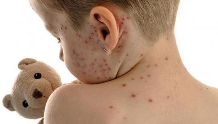 С дребна шарка са 13 малчугана от детски градини в Русе С дребна шарка са 13 малчугана от детски градини в Русе