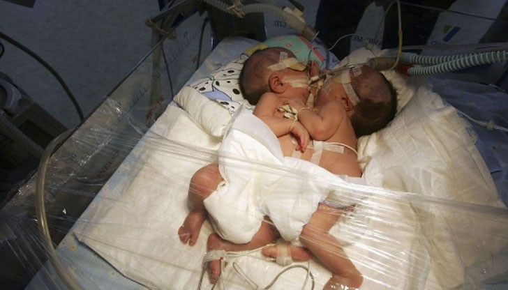 Бебето не може да оцелее без тези органи, затова лекарите се борят за живота на другото дете / Снимката е илюстративна Бебето не може да оцелее без тези органи, затова лекарите се борят за живота на другото дете / Снимката е илюстративна
