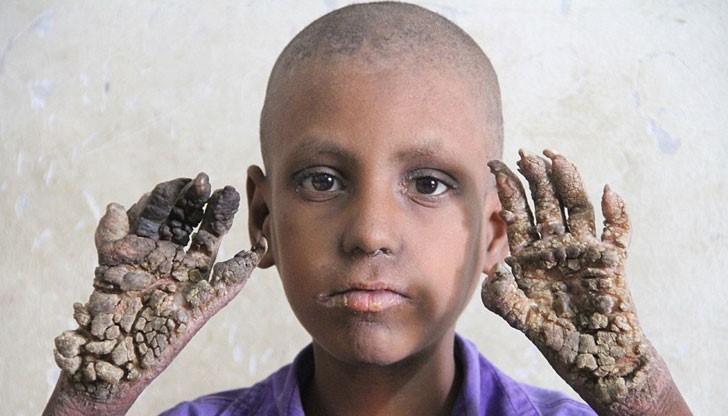 Момчето не може да върви и да се храни самостоятелно