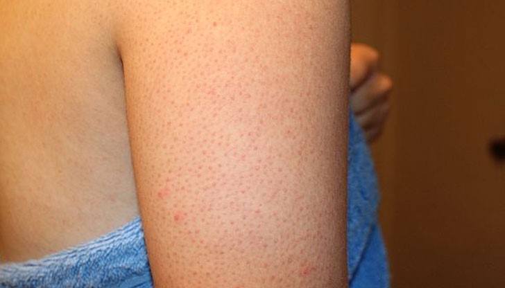 Естествени средства, които могат да ви помогнат да се намалят симптомите