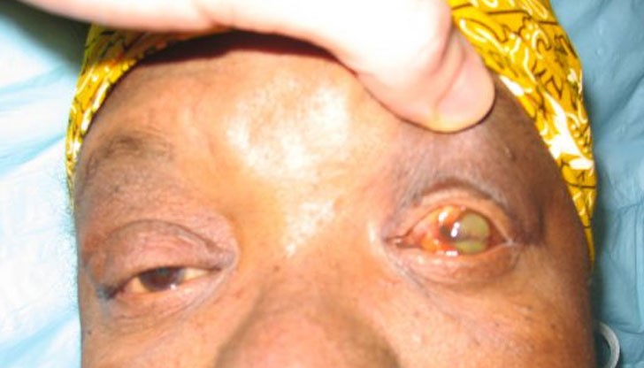 Най-тревожното, че няма лек срещу жълтата треска Най-тревожното, че няма лек срещу жълтата треска