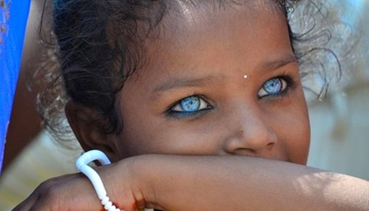 Според учените синдромът на Ваарденбург се дължи на генетична мутация