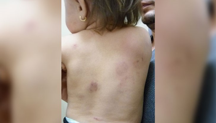 Медицинската сестра на ОДЗ "Веселушко" е отстранена от работа заради случая с малката Берна Медицинската сестра на ОДЗ "Веселушко" е отстранена от работа заради случая с малката Берна