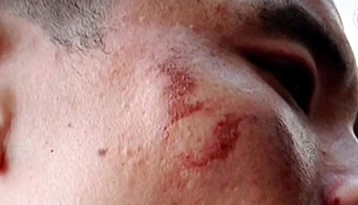 Смартфонът избухнал в ръцете на собственика си, докато снимал видео Смартфонът избухнал в ръцете на собственика си, докато снимал видео