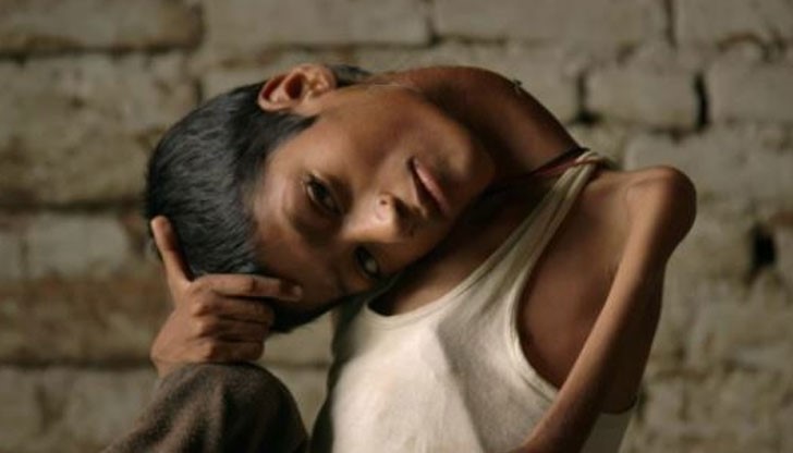 13-годишният ученик стана известен с необичайното си здравословно състояние