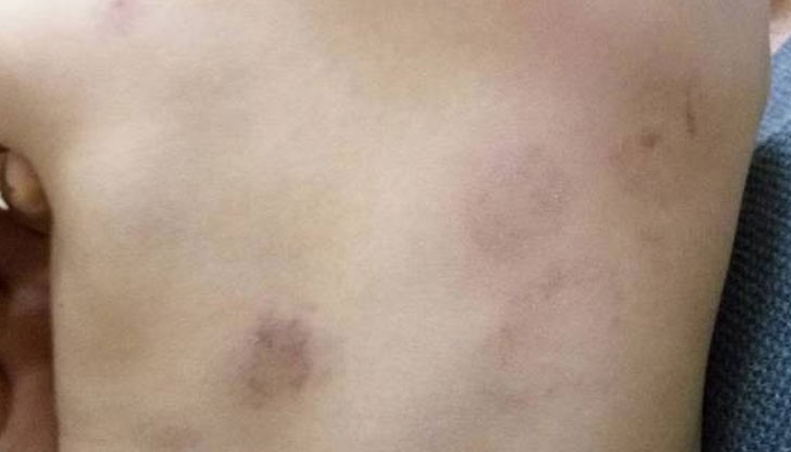 Момиченцето й е нахапано от други деца, а сестрата, която е трябвало да ги гледа е спяла...