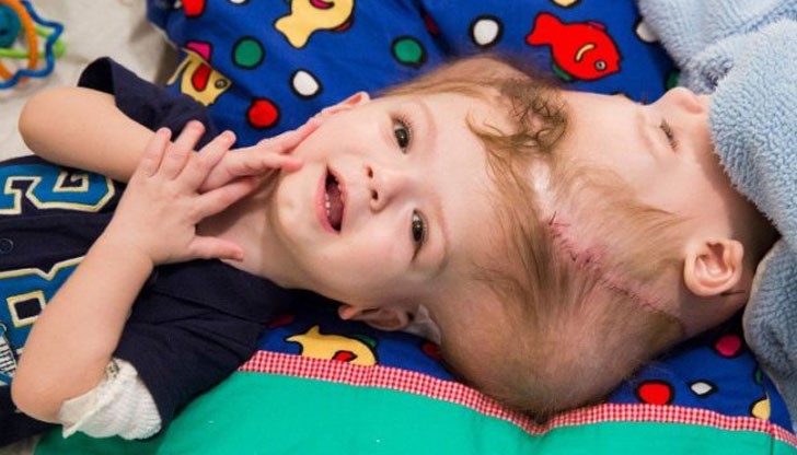 Цял ден хирурзи са извършвали операции, за да разделят главите на 13-месечните Джейдън и Ениас Макдоналд