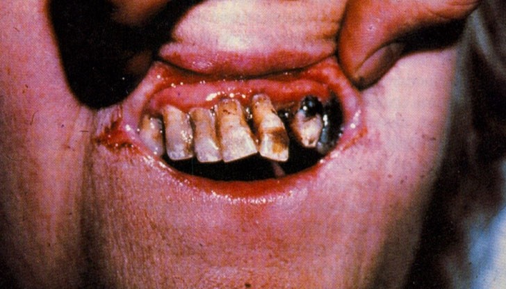 Лекари се натъкнаха на голям брой пациенти, чиито рани дълго не зараствали Лекари се натъкнаха на голям брой пациенти, чиито рани дълго не зараствали