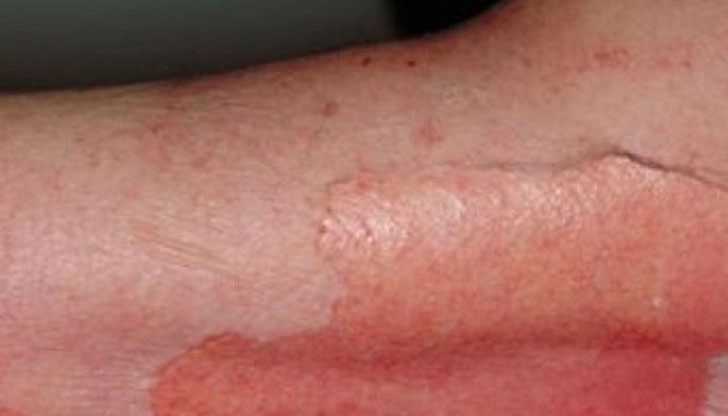 72-годишна жена развила синдрома на Лайл, при който кожата се свлича, като след тежко изгаряне 72-годишна жена развила синдрома на Лайл, при който кожата се свлича, като след тежко изгаряне