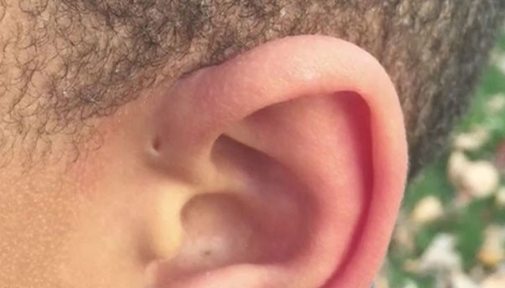 Ако вие сте един от хората, които разполагат с преаурикуларен синус, не е нужно да се притеснявате