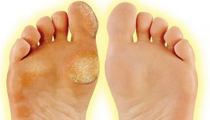 Основната причина за появата на мазоли е употребата на твърди и неудобни обувки