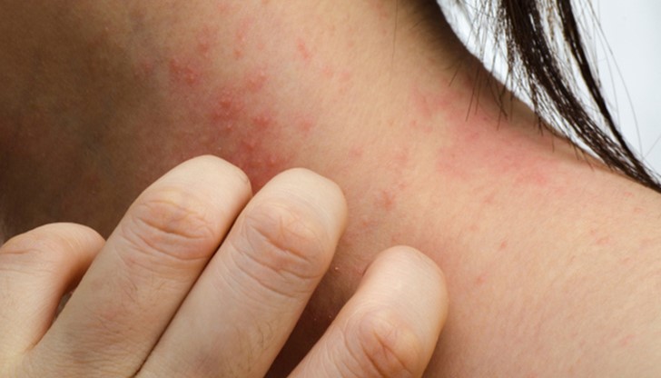 Бактерията е открита и при пациенти, засегнати и незасегнати от кожни заболявания