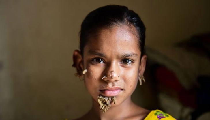 По лицето на 10-годишната Сахана Хатун има големи кожни израстъци, характерни за болестта с официално название веруциформна епидермодисплазия