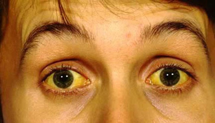 18 жители на село Раданово, област Велико Търново, са се разболели от хепатит А през последния месец