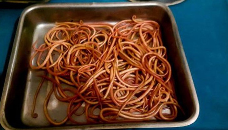 Лекари от Индия са премахнали около 150 живи паразитни червеи от червата на млада жена