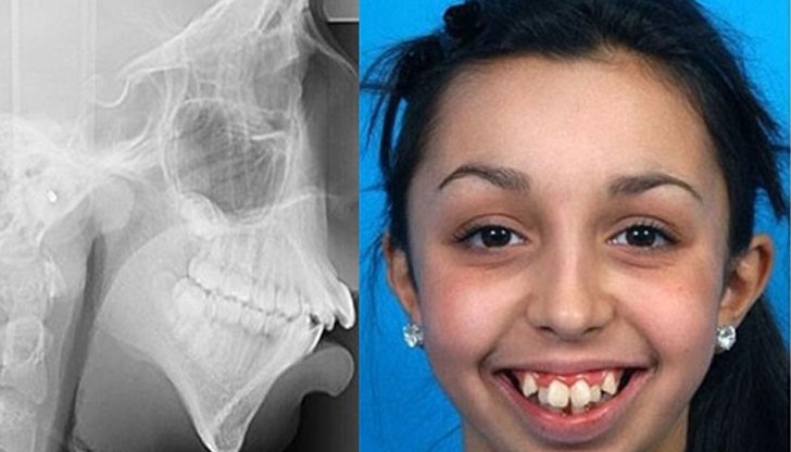 Това момиче се ражда с тежко изкривяване на челюстта, което размества цялата й захапка и положение на зъбите