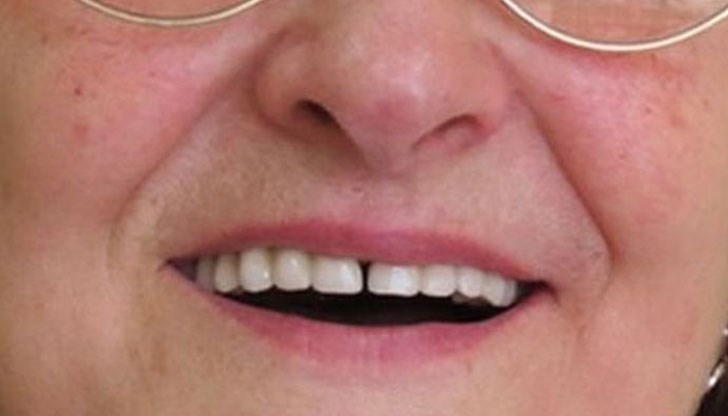 Обмислят Здравната каса да плаща за зъбни протези при възрастните хора