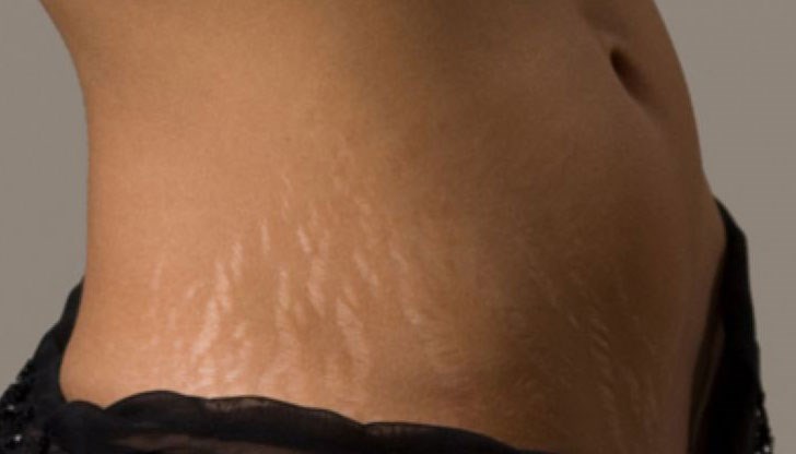 Тази рецепра ще ви освободи от неприятните белези