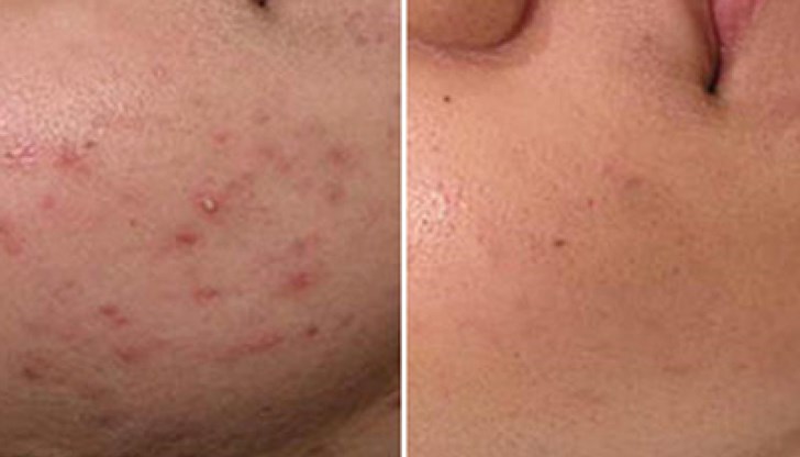 Най-доброто решение за премахване на акне, в действителност е промяна в начина на хранене Най-доброто решение за премахване на акне, в действителност е промяна в начина на хранене