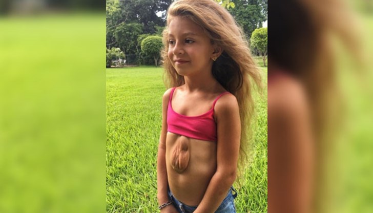 Момиченцето страда от синдром, който се появява веднъж на 5,5 милиона раждания