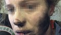 Жена е с изгаряния, след като слушалките й избухнаха