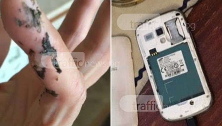 Разтопената пластмаса буквално се е залепила за кожата му