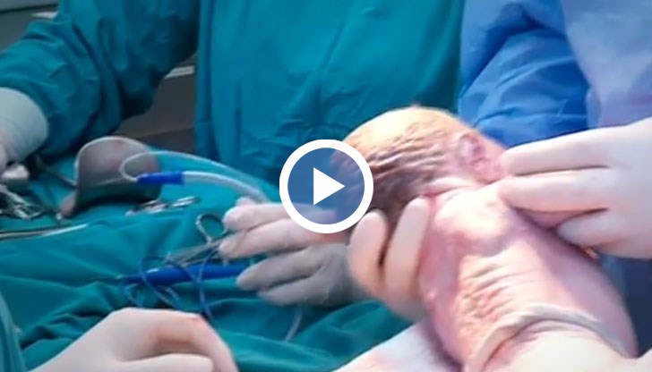 Това е цезарово сечение, което наподобява естественото раждане