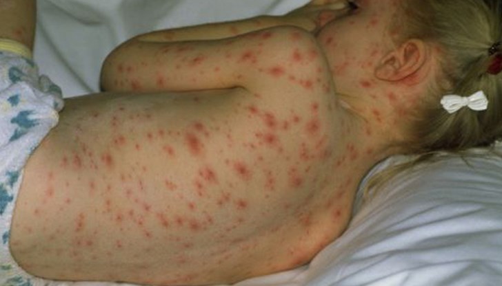 Новият случай на морбили при възрастните е на медицинска сестра Новият случай на морбили при възрастните е на медицинска сестра