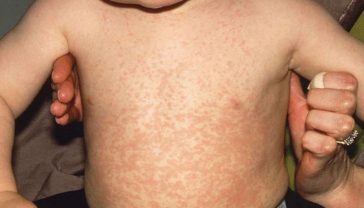 Повечето пациенти са деца между 3 месеца и 4 години / Снимката е илюстративна