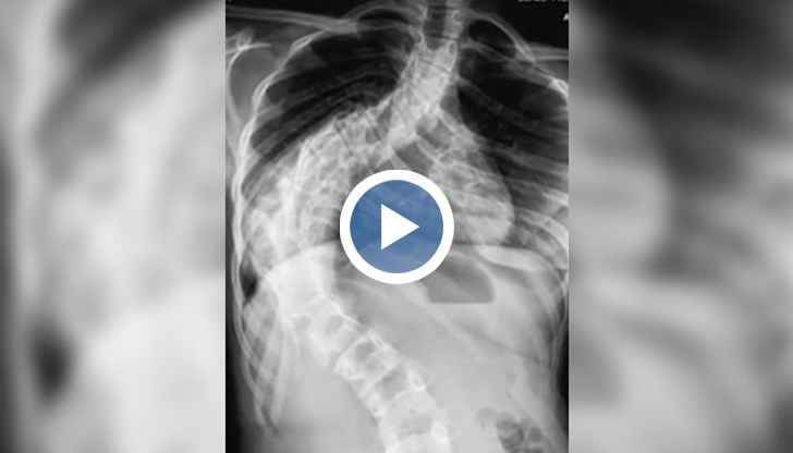 Отлагат лечението на 14-годишно момиче с тежко гръбначно заболяване заради неуредици във Фонда