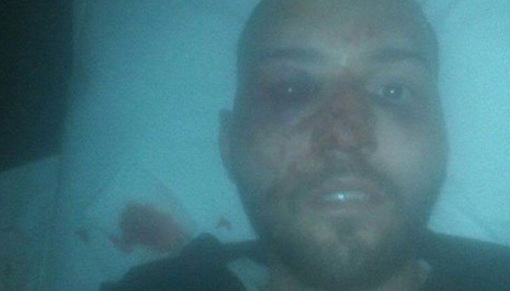 Счупиха ми нос, зъби, бях в болница два дни Счупиха ми нос, зъби, бях в болница два дни