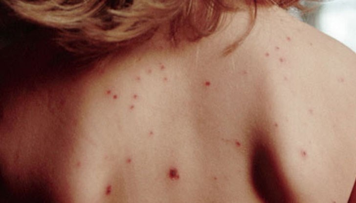 Епидемията от морбили в България през 2009-2010 г. е най-тежката в Европа. Ще се повтори ли?