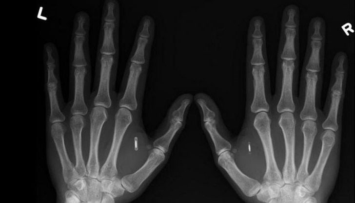 Вече 150 души имат имплант в ръцете си