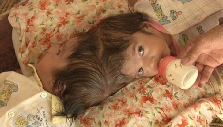 Това е рядък случай, който се забелязва веднъж на 2.5 милиона раждания