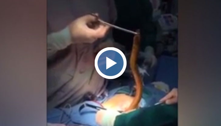 На кадрите се вижда как хирург издърпва животното от тялото на пациента