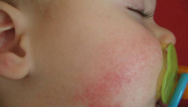 Откритието ще помогне да създадат лекарства, които да предотвратят болезненото състояние