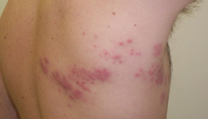 Бум на инфекции от вирус, като този на варицелата