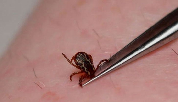 По 100 души всеки ден търсят медицинска помощ, за да бъде изваден кърлежът