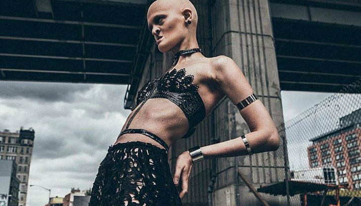 Това е Мелани. Тя страда от "ектодермална дисплазия"